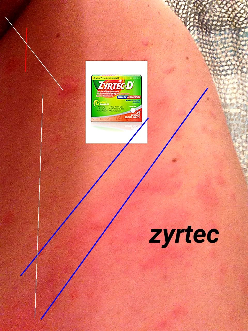 Générique zyrtec